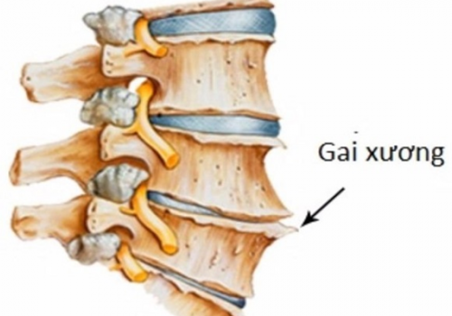NGUYÊN NHÂN, DẤU HIỆU VÀ CÁCH ĐIỀU TRỊ BỆNH GAI CỘT SỐNG