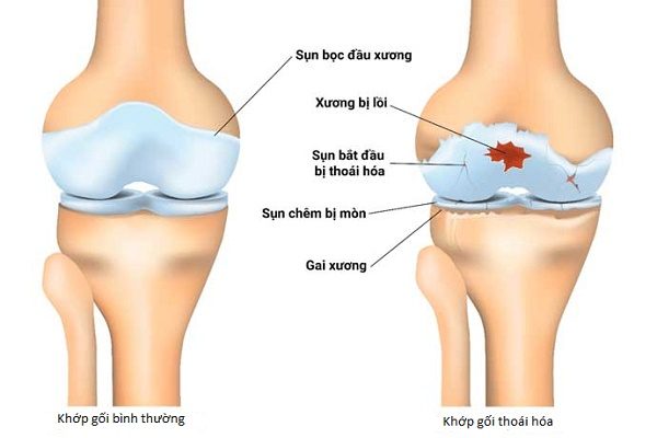 Nibifa thoai hoa khop