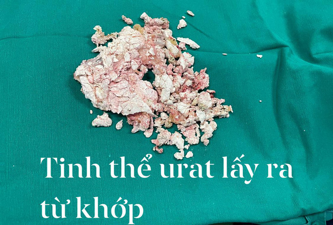 TINH THE MUOI URAT