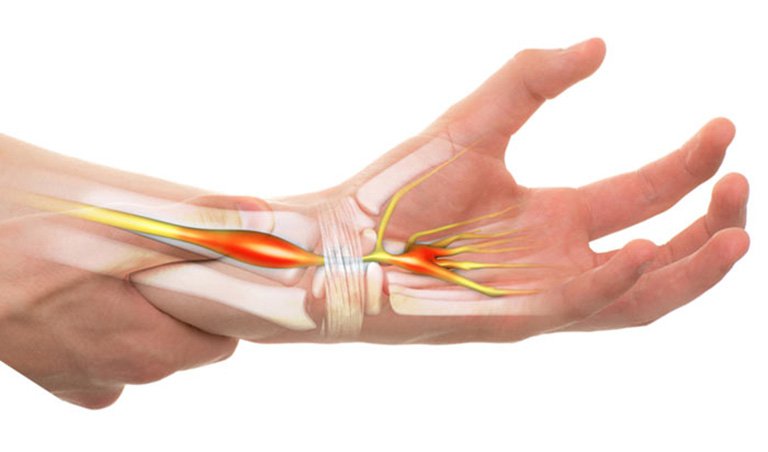 Xương Khớp Nibifa - hội chứng ống cổ tay