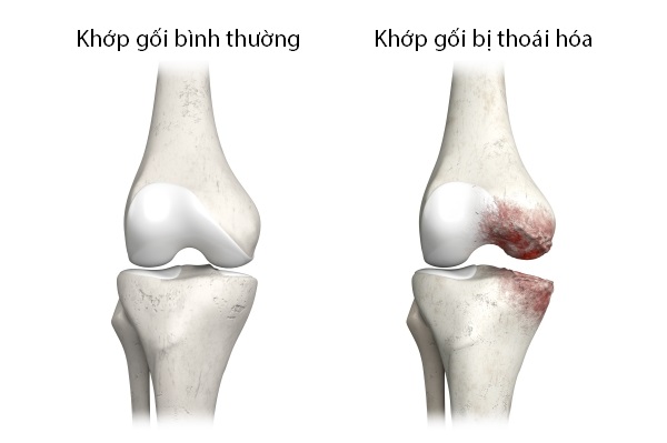 thoai-hoa-khop-goi